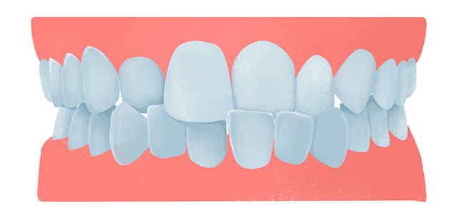 Omgekeerde occlusie of kruisbeet